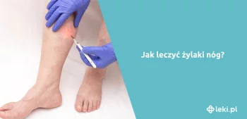 Ilustracja poradnika Jak powinno wyglądać leczenie żylaków?