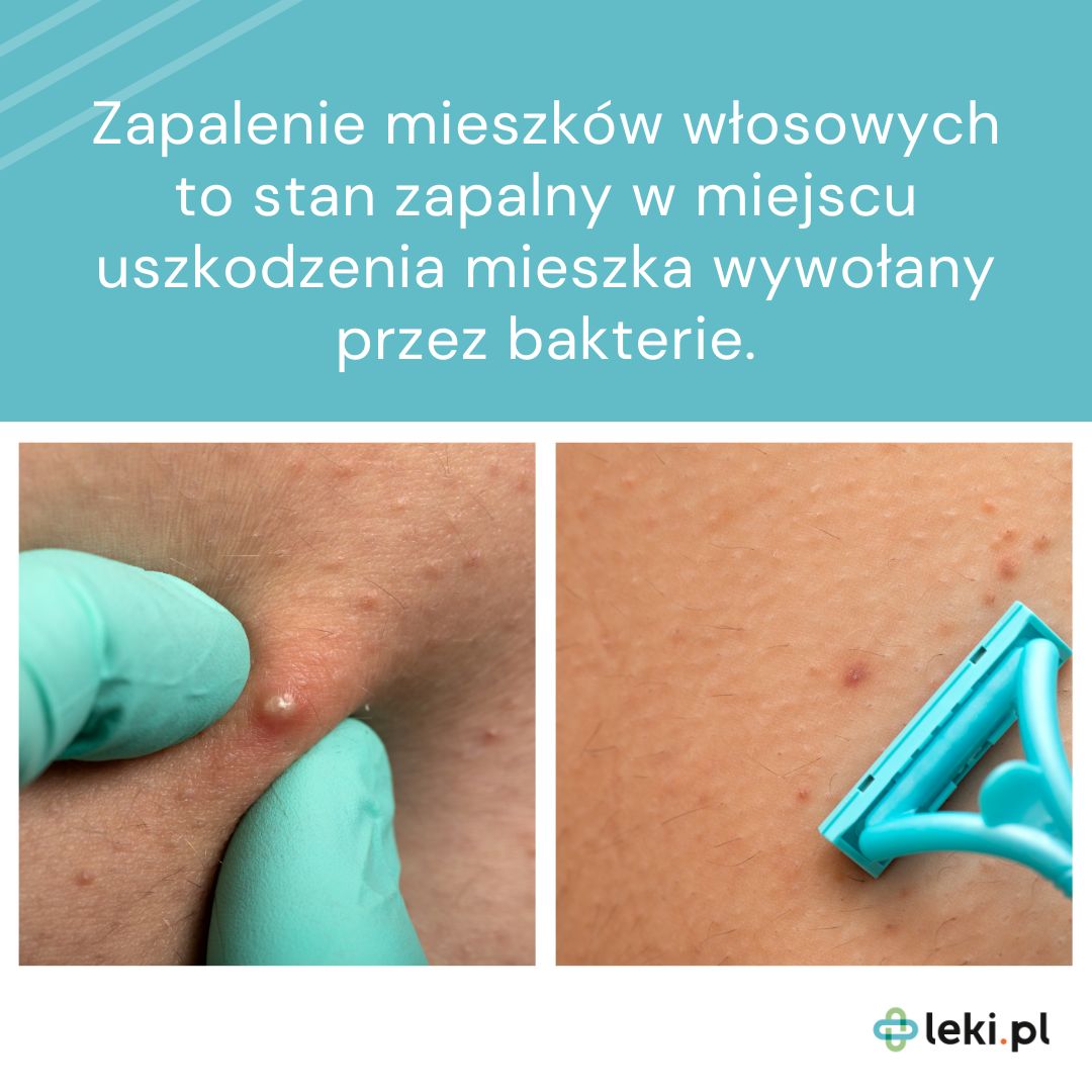 Definicja zapalenia mieszków włosowych (fot. leki.pl)