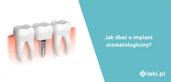 Ilustracja poradnika Implant stomatologiczny, jak dbać o higienę po zabiegu ?