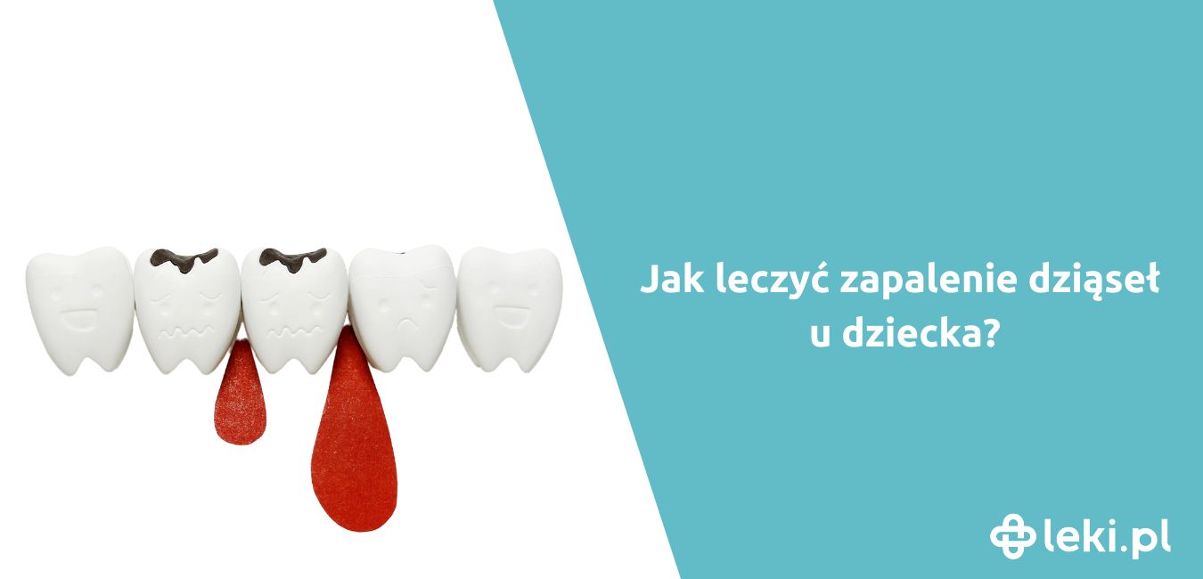 Jak leczyć zapalenie dziąseł u dziecka?