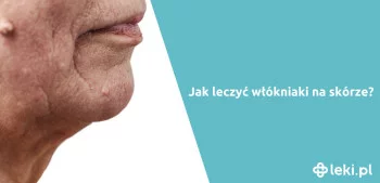 Ilustracja poradnika Jakie preparaty na włókniaki znajdziesz w aptece?