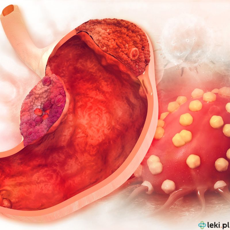 Jakie są nowe metody leczenia raka żołądka? (fot. Canva)