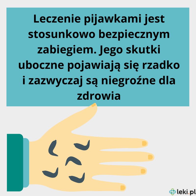 Jak wygląda leczenie pijawkami?